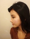 Forehead fat grafting + Rhinoplasty — Korea cost, reviews & before-after | MISOODA