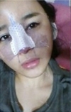 Forehead fat grafting + Rhinoplasty — Korea cost, reviews & before-after | MISOODA