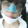 Nose Revision Surgery (3 times) — Korea cost, reviews & before-after | MISOODA