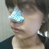 Nose Revision Surgery (3 times) — Korea cost, reviews & before-after | MISOODA
