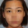 Incisional Double Eyelid, Lateral Canthoplasty, Eyelid Fat Removal — Korea cost, reviews & before-after | MISOODA