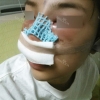 Nose Revision Surgery (3 times) — Korea cost, reviews & before-after | MISOODA
