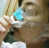 Nose Revision Surgery (3 times) — Korea cost, reviews & before-after | MISOODA