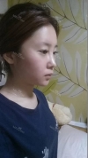 Face Liposuction — Korea cost, reviews & before-after | MISOODA