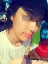Nose Revision Surgery (3 times) — Korea cost, reviews & before-after | MISOODA