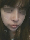 Nose Revision Surgery (3 times) — Korea cost, reviews & before-after | MISOODA