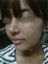Nose Revision Surgery (3 times) — Korea cost, reviews & before-after | MISOODA