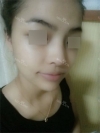 Nose Revision Surgery (3 times) — Korea cost, reviews & before-after | MISOODA