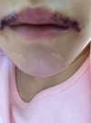 Lips and Fat Graft — Korea cost, reviews & before-after | MISOODA