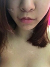 lips correction — Korea cost, reviews & before-after | MISOODA