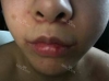 lips correction — Korea cost, reviews & before-after | MISOODA