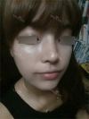 Nose Revision Surgery (3 times) — Korea cost, reviews & before-after | MISOODA