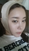 Face Liposuction — Korea cost, reviews & before-after | MISOODA