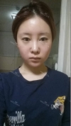 Face Liposuction — Korea cost, reviews & before-after | MISOODA