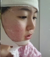 Jaw chin — Korea cost, reviews & before-after | MISOODA