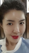 Stem cell Fat grafting + Smile V Lifting + Laser Lifting — Korea cost, reviews & before-after | MISOODA