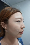 Nose Fillers — Korea cost, reviews & before-after | MISOODA