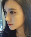 facial contouring — Korea cost, reviews & before-after | MISOODA