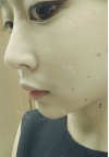natural nose — Korea cost, reviews & before-after | MISOODA