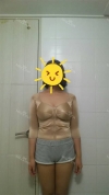 Arms, Braline, Thighs Liposuction — Korea cost, reviews & before-after | MISOODA