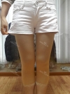 Sedot Lemak Lengan, Perut dan Paha — Korea cost, reviews & before-after | MISOODA