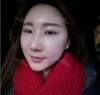 Rhinoplasty + Eyelid + Fat Grafting surgery — Korea cost, reviews & before-after | MISOODA
