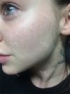 UK Model PIXIEE's skin treatment in Korea — Korea cost, reviews & before-after | MISOODA