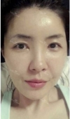 Stem cell Fat grafting + Smile V Lifting + Laser Lifting — Korea cost, reviews & before-after | MISOODA