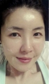 Stem cell Fat grafting + Smile V Lifting + Laser Lifting — Korea cost, reviews & before-after | MISOODA