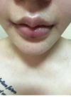 my beautiful lips — Korea cost, reviews & before-after | MISOODA