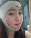 Jaw chin — Korea cost, reviews & before-after | MISOODA