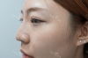 Nose Fillers — Korea cost, reviews & before-after | MISOODA