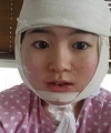 Jaw chin — Korea cost, reviews & before-after | MISOODA