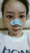 natural nose — Korea cost, reviews & before-after | MISOODA
