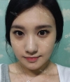 facial contouring — Korea cost, reviews & before-after | MISOODA