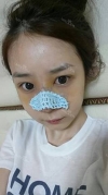 natural nose — Korea cost, reviews & before-after | MISOODA