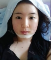 Jaw chin — Korea cost, reviews & before-after | MISOODA