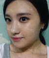 facial contouring — Korea cost, reviews & before-after | MISOODA