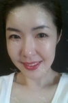 Stem cell Fat grafting + Smile V Lifting + Laser Lifting — Korea cost, reviews & before-after | MISOODA
