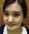 facial contouring — Korea cost, reviews & before-after | MISOODA