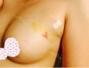 Breast fat graft liposuction — Korea cost, reviews & before-after | MISOODA