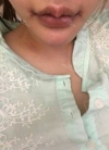my beautiful lips — Korea cost, reviews & before-after | MISOODA