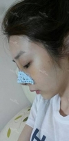 natural nose — Korea cost, reviews & before-after | MISOODA