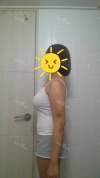 Arms, Braline, Thighs Liposuction — Korea cost, reviews & before-after | MISOODA
