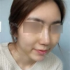 Nose Bridge + Tip Augmentation — Korea cost, reviews & before-after | MISOODA