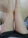 Lower body thigh liposuction — Korea cost, reviews & before-after | MISOODA