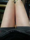 Lower body thigh liposuction — Korea cost, reviews & before-after | MISOODA