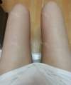 Lower body thigh liposuction — Korea cost, reviews & before-after | MISOODA