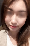 Nose Bridge + Tip Augmentation — Korea cost, reviews & before-after | MISOODA