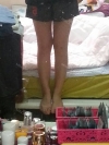 Lower body thigh liposuction — Korea cost, reviews & before-after | MISOODA